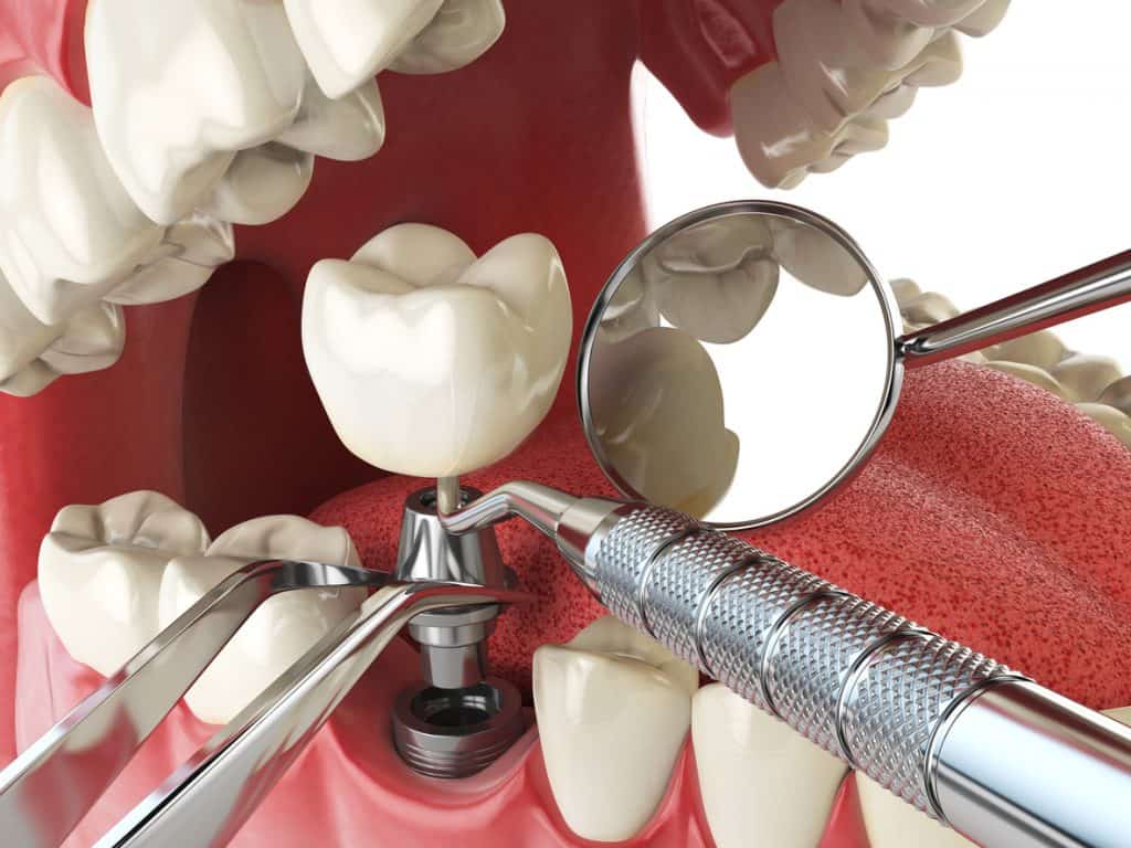 implantes dentales baratos