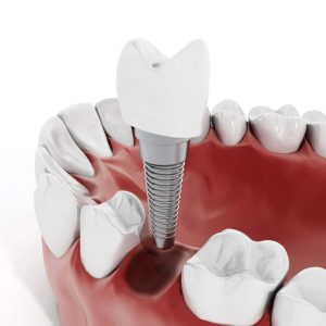 Riesgos de los implantes