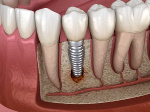 Riesgos de los implantes en el postoperatorio