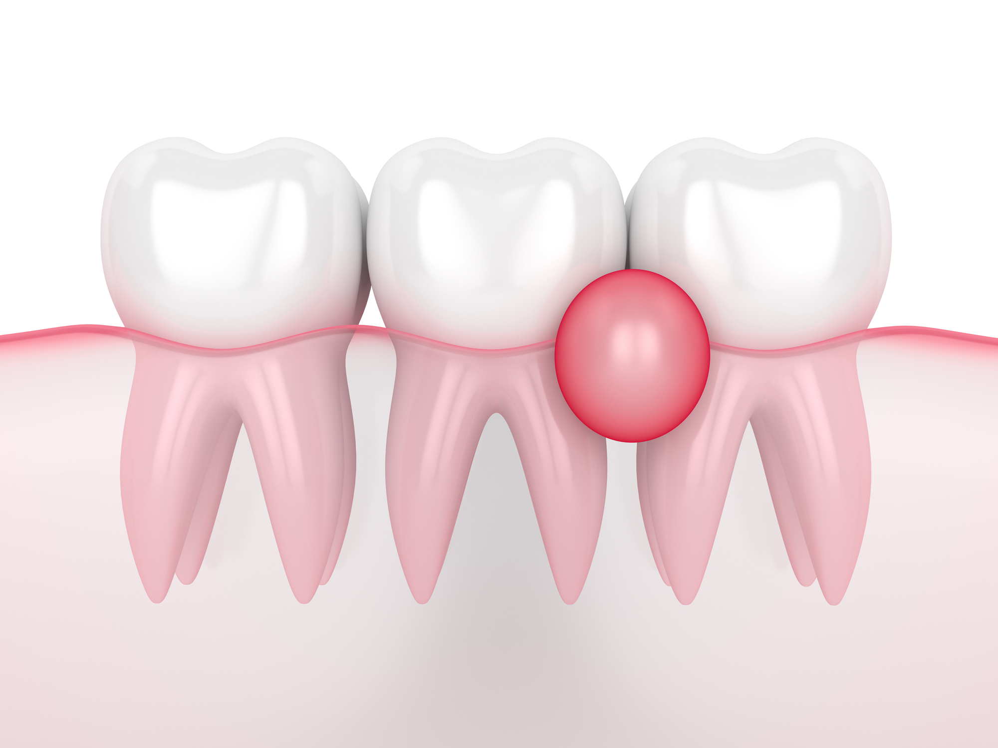 Quistes dentales causas, síntomas y tratamiento Quistes dentales causas, síntomas y tratamiento